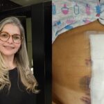 Sem sintomas, brasileira que vive na Irlanda descobre tumor raro de 20 cm em exames de rotina e busca ajuda: ‘tinha vida normal’ | Mais Saúde